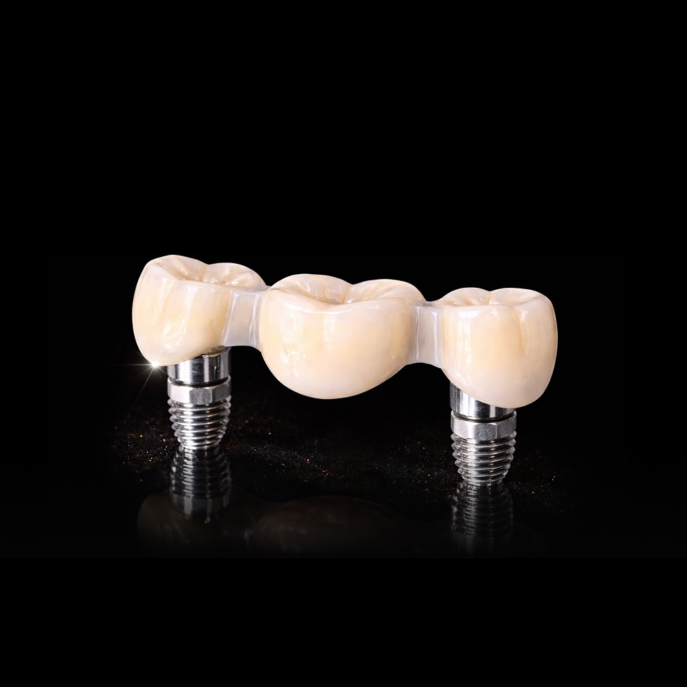 Implant Restorations