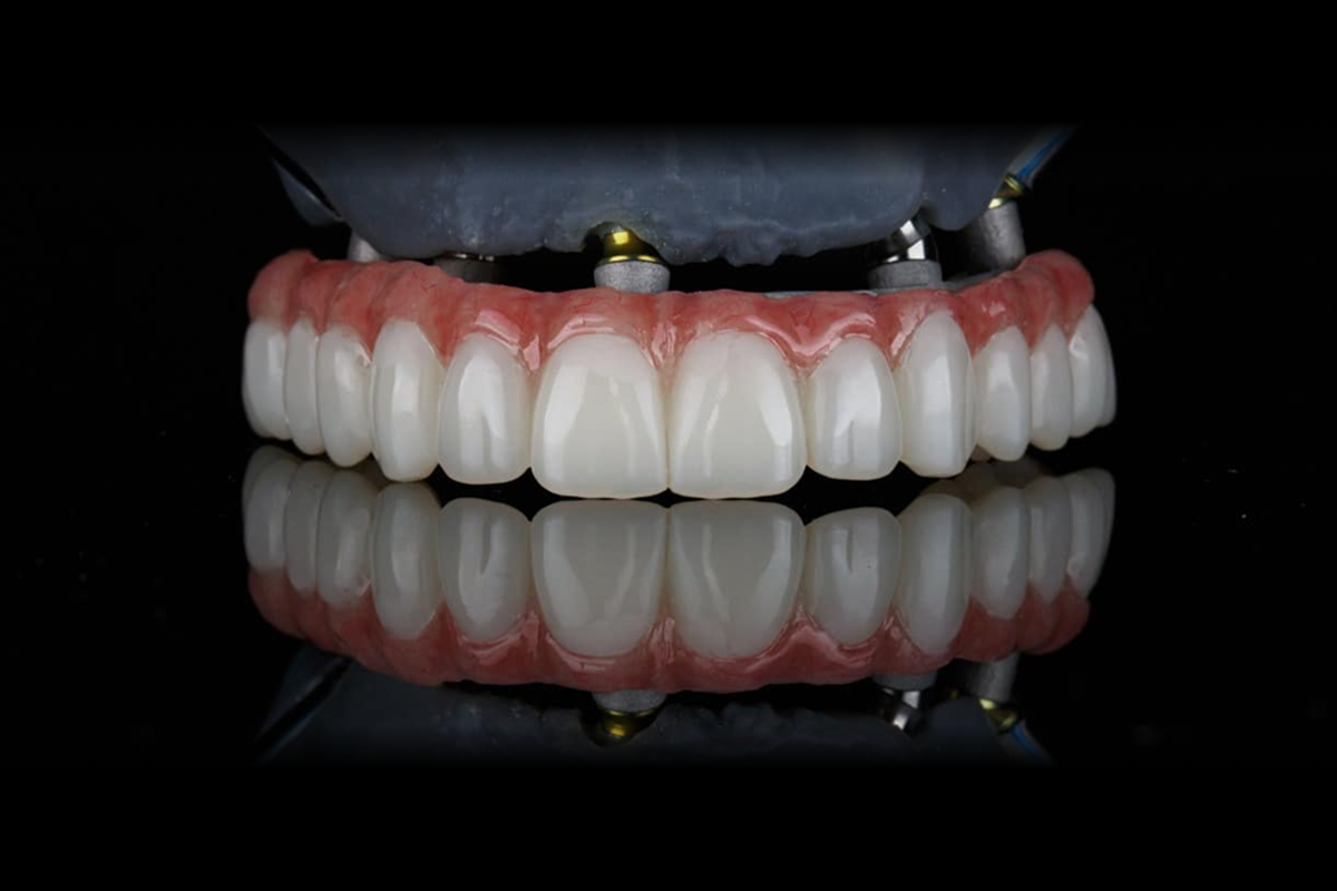 All-on-X restoration on multi-unit abutments