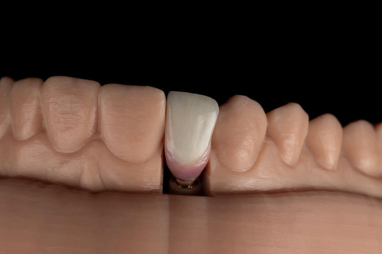 Implant crown and bridge restoration