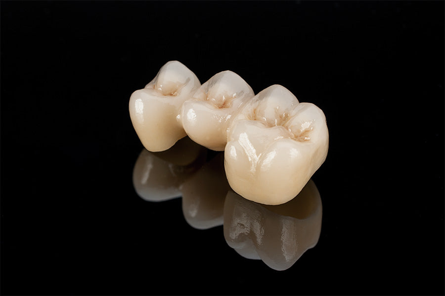 Porcelain fused zirconia crown result for ArtyCad PFZ crowns