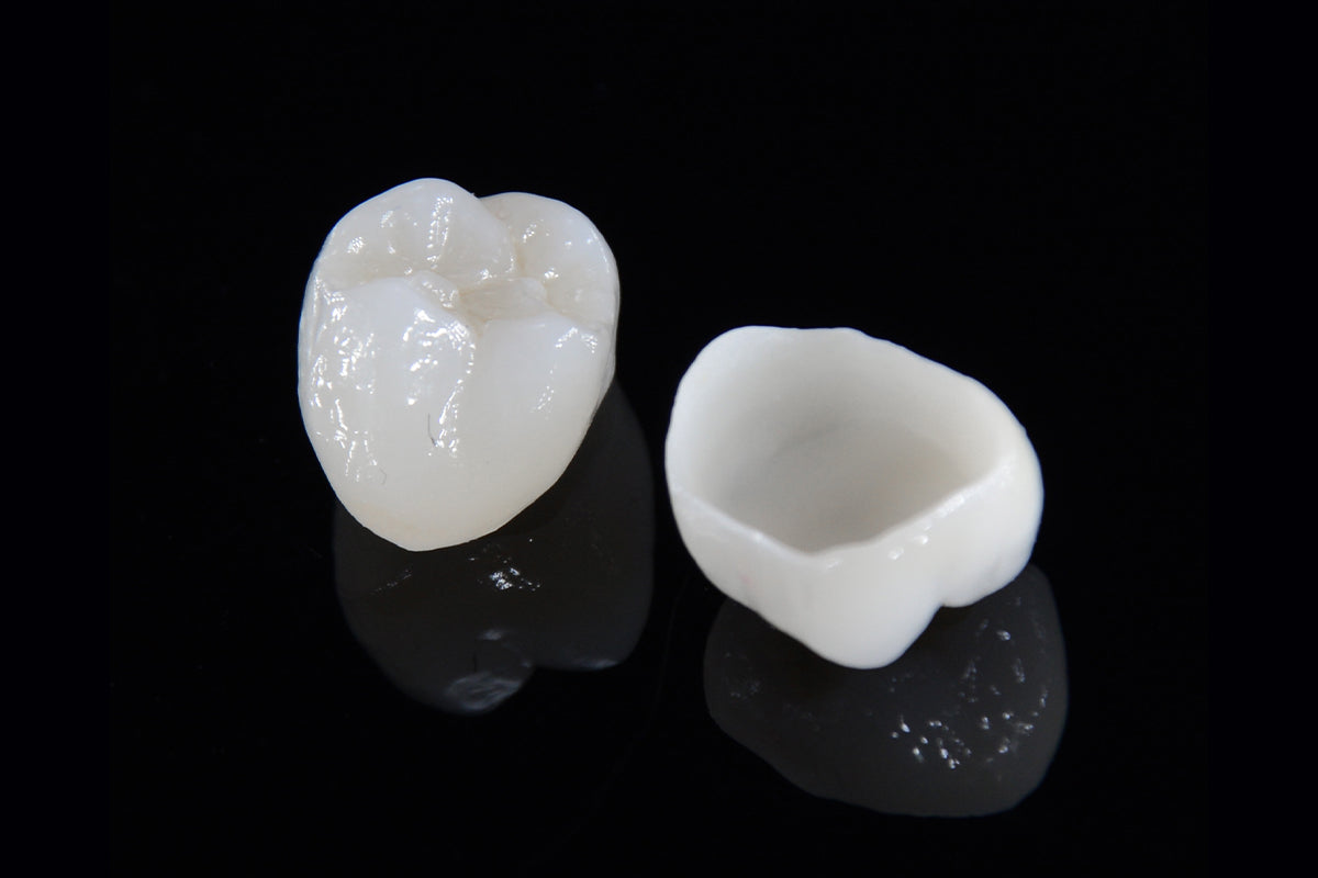 PMMA implant temporary workflow