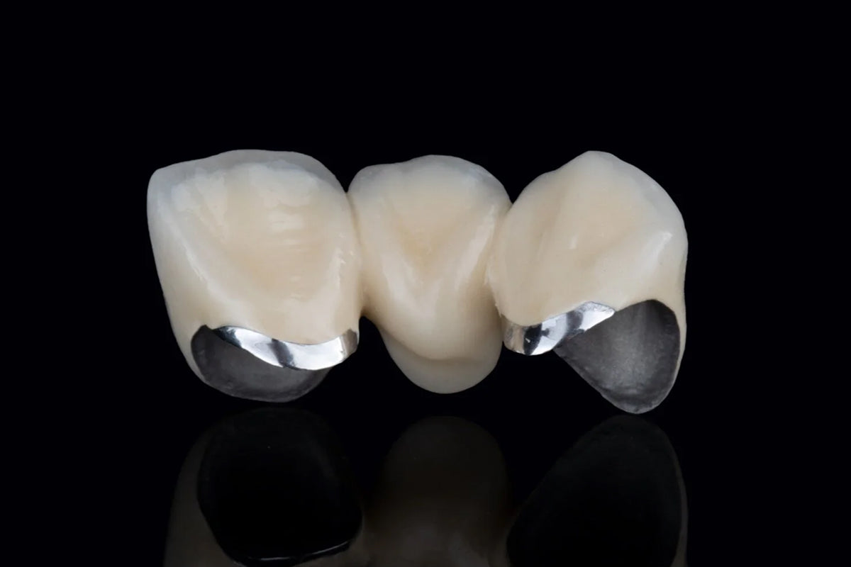 SLM printed metal framework for ArtyCad PFM crowns