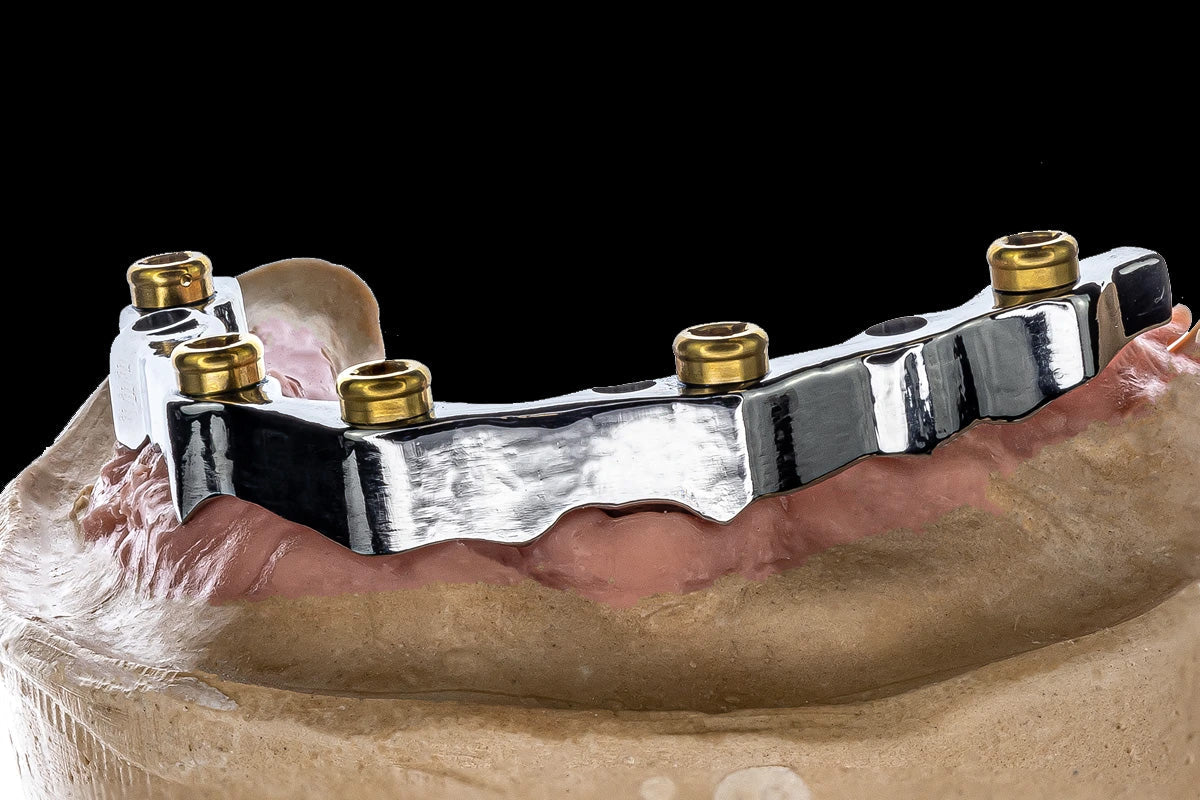 Titanium implant bar framework