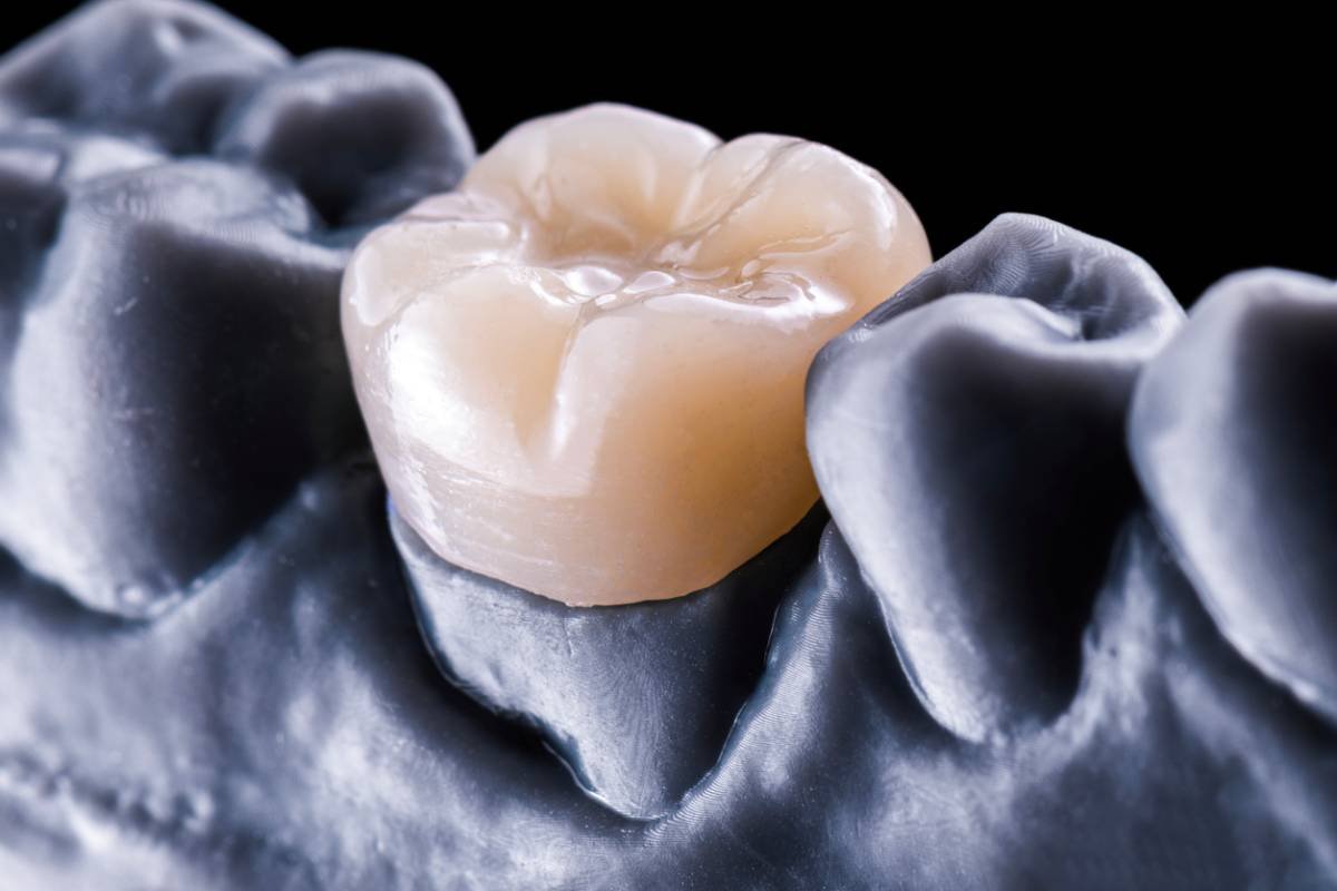 Posterior molar crown restoration for ArtyCad zirconia crowns