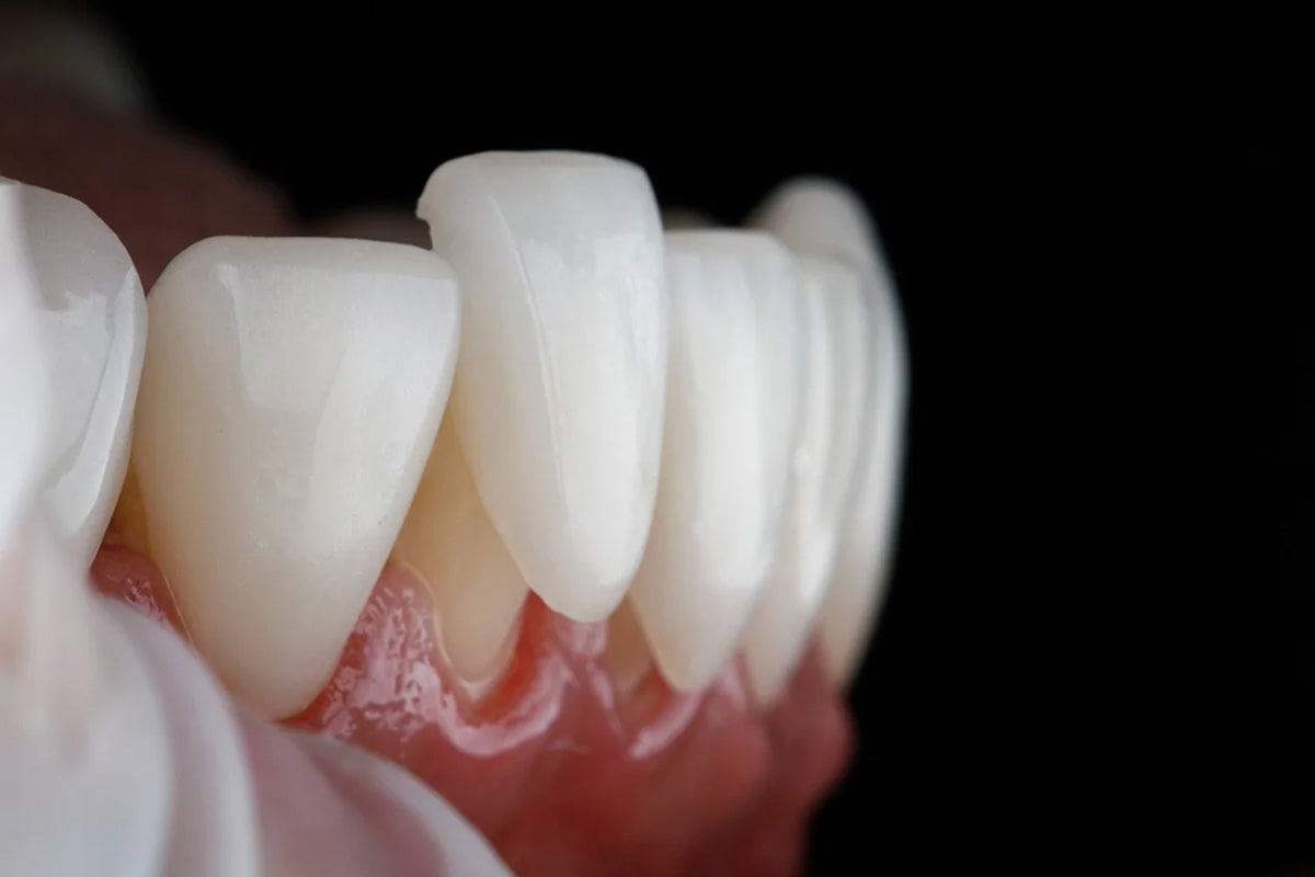 Anterior veneer result for ArtyCad zirconia veneers